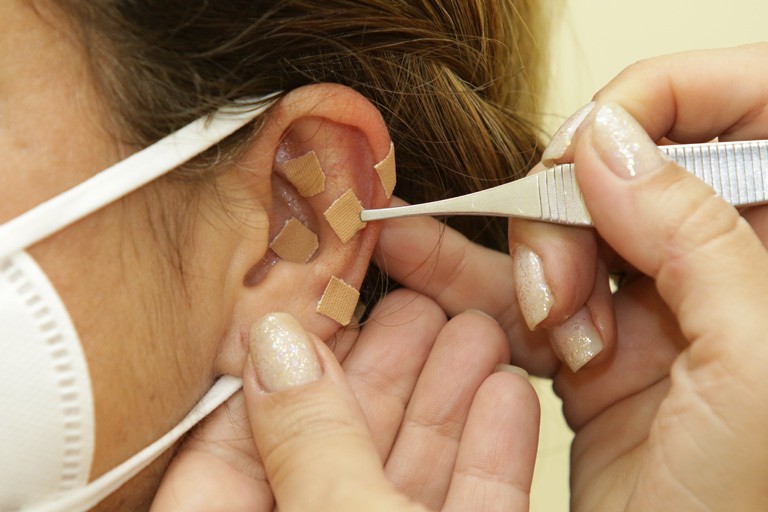 A auriculoterapia é uma especialidade da acupuntura e parte essencial da medicina tradicional chinesa